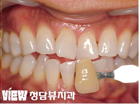 치아미백